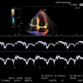Dormed Hellas Ascendus - Cardiac TDI