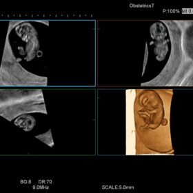 Dormed Hellas Ascendus - OB 4D Vaginal