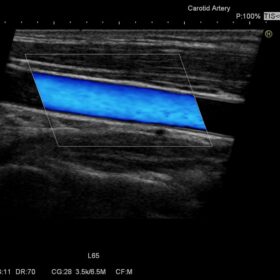 Dormed Hellas Avius - Carotid
