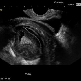 Dormed Hellas Avius - Obsestics vaginal