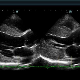 Dormed Hellas 880 Ultrasound - BEAT MODE Hypertrophic Aardiomyopathy