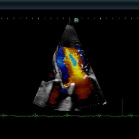 Dormed Hellas 880 Ultrasound - Color Doppler, AO Regurgitation & Mitral Inflow