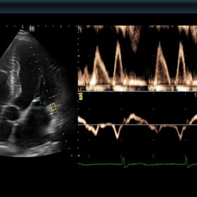 Dormed Hellas 880 - Dual Gate Doppler, Automatic E-e' measurement