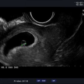 Dormed Hellas F37 - Fetal