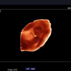 Dormed Hellas F75 - Fetal 4DShading