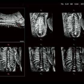 Dormed Hellas Futus - Fetal Spine 3D