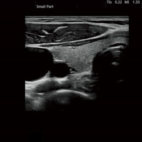 Dormed Hellas Futus - Thyroid