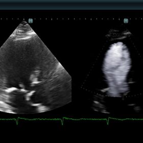 Dormed Hellas 880 - LV eFLOW, Technically difficult patient
