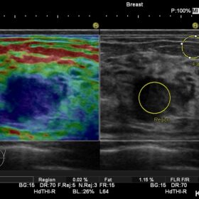 Dormed Hellas Noblus - Breast Elasto