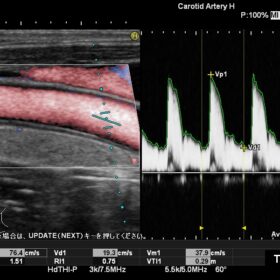 Dormed Hellas Noblus - Carotid power Doppler