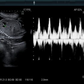 Dormed Hellas AR750 Obstetrics Doppler