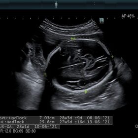 Dormed Hellas AR750 Fetal Head