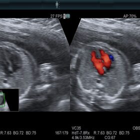 Dormed Hellas AR750 Fetal Heart