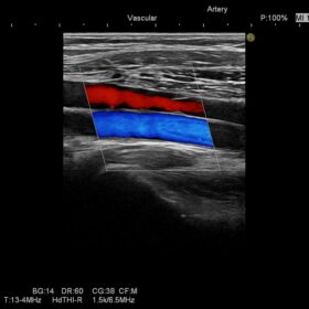 Dormed Hellas Preirus - Vascular Leg