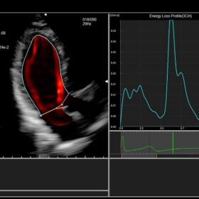 Dormed Hellas 880 - VFM-Energy Loss Profile with a normal patient