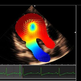 Dormed Hellas 880 - VFM-relative pressure with a Dilated Cardiomyopathy