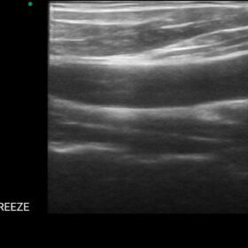 Dormed Hellas Wifi Linear carotid 2