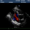 Dormed Hellas S5-1_6 Phased Array Cardiology
