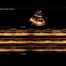 MX7 natomical M Mode