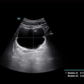 Dormed Hellas Mindray Consona N6 Smart Bladder Transverse plane