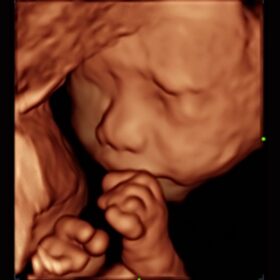 Dormed Hellas Mindray Consona N6 Fetal Face iLive