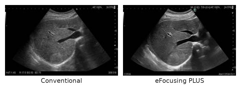 Σύγκριση: Conventional vs eFocusing PLUS