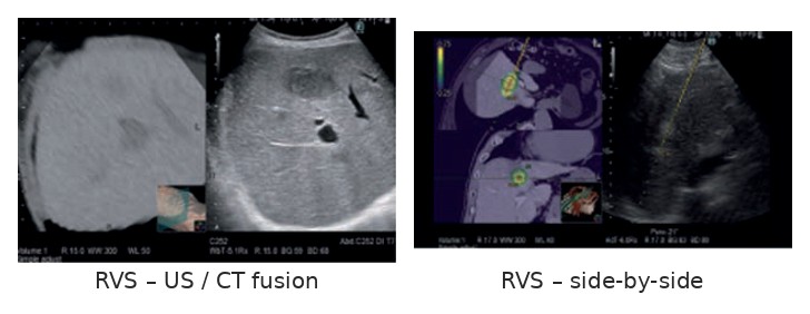 Real-time Virtual Sonography – σύντηξη US με CT/MRI